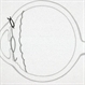 Scleral Fixated 10L Cartoon
